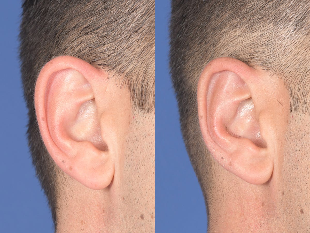 Otoplasty Before & After Gallery - Patient 381655 - Image 5