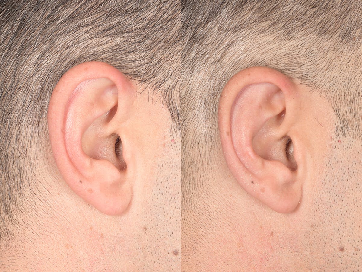 Otoplasty Before & After Gallery - Patient 381655 - Image 6