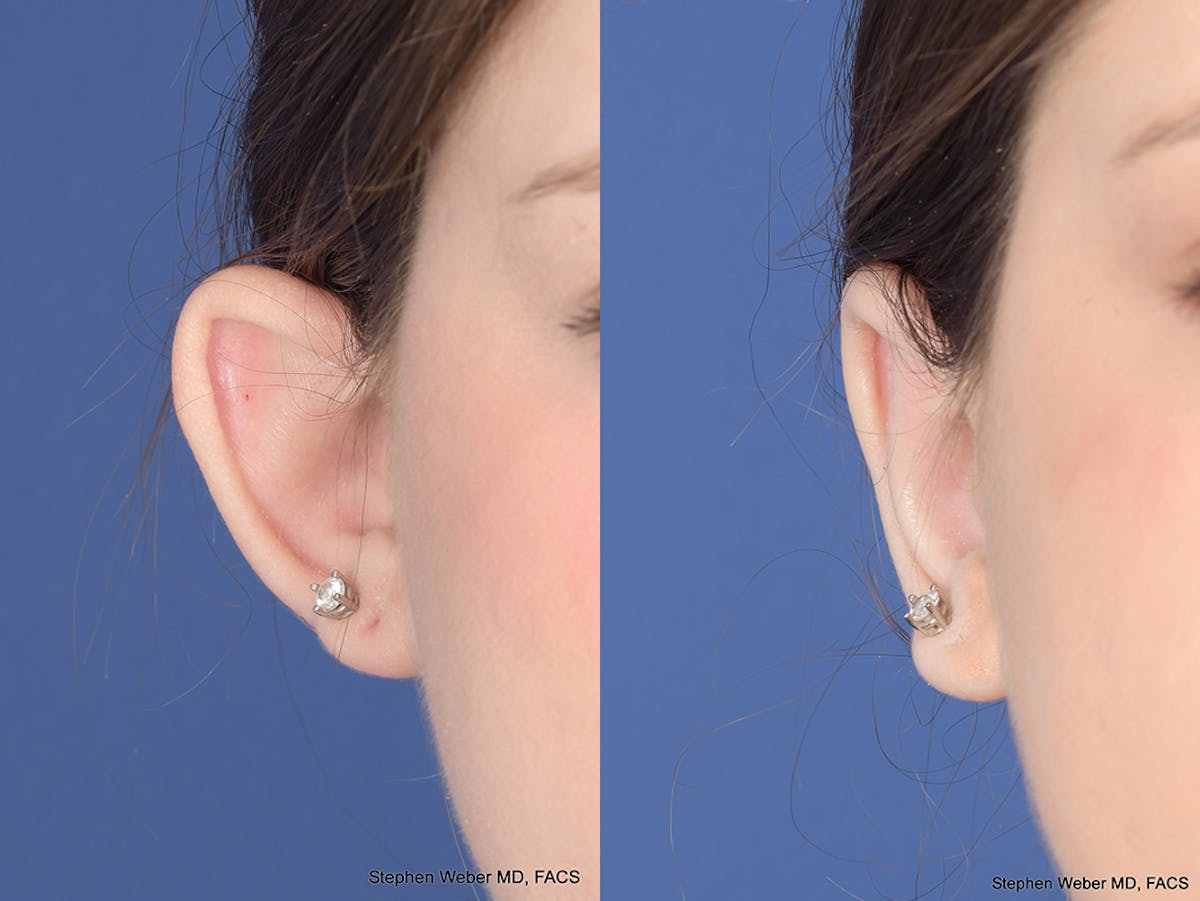 Otoplasty Before & After Gallery - Patient 253251 - Image 1