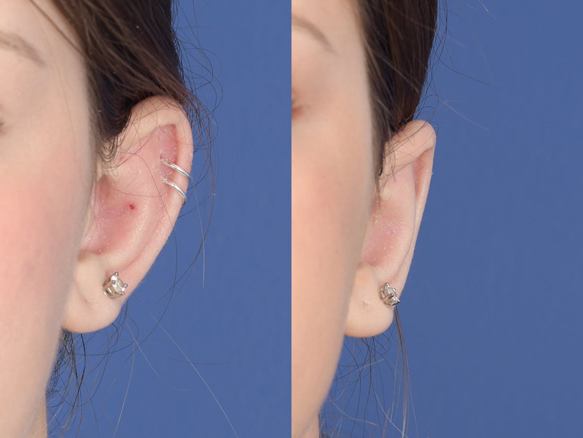 Otoplasty Before & After Gallery - Patient 253251 - Image 2