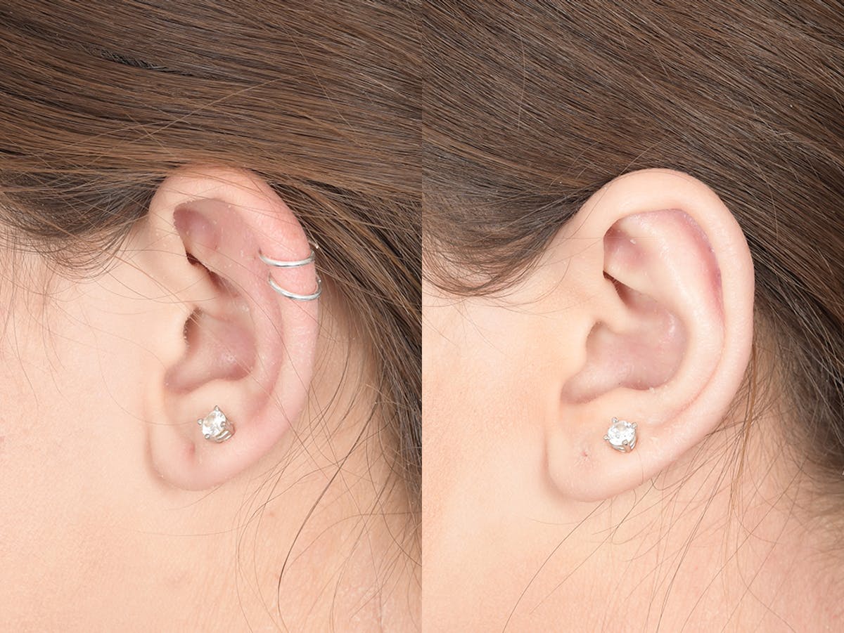 Otoplasty Before & After Gallery - Patient 253251 - Image 3