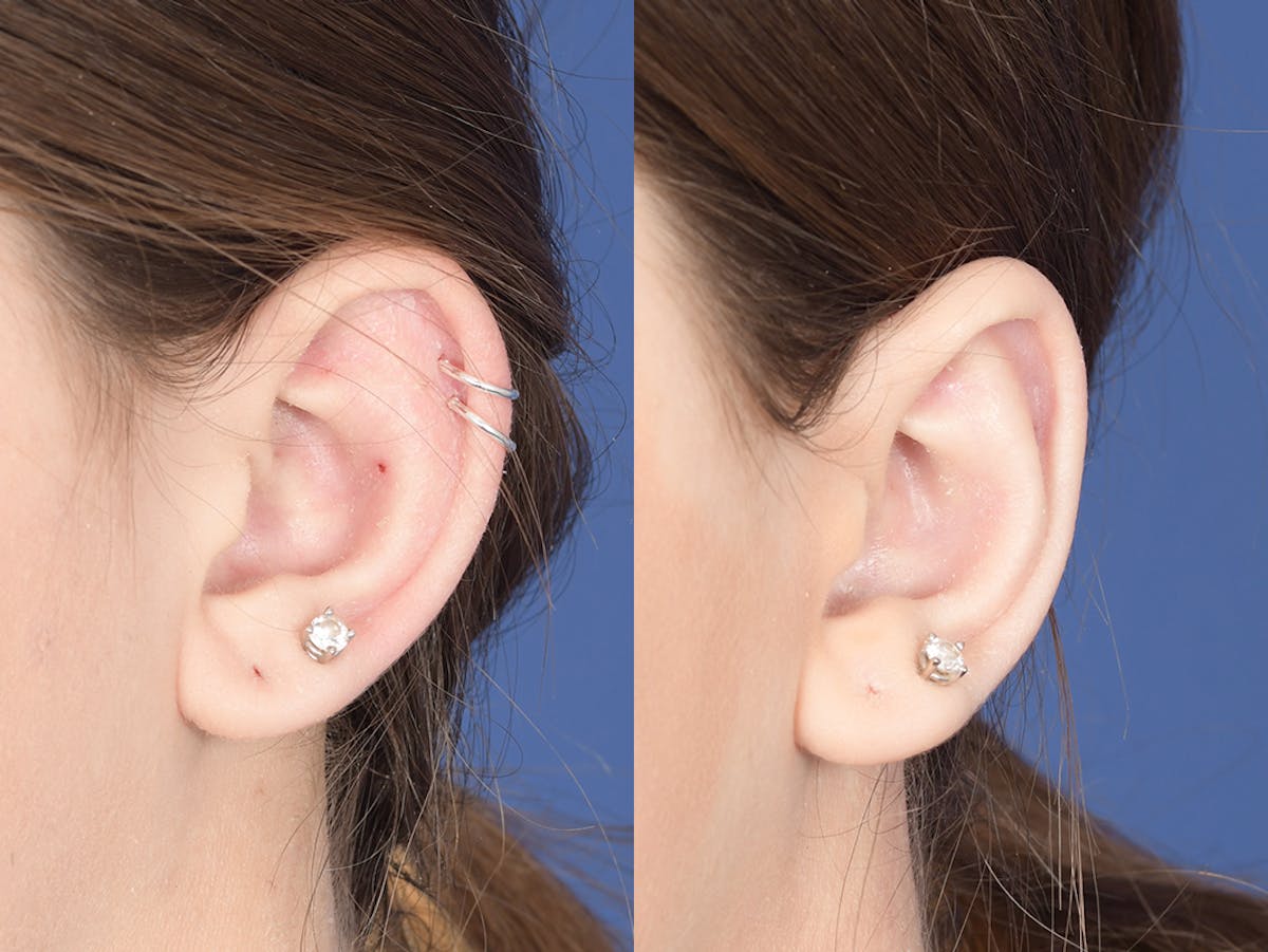 Otoplasty Before & After Gallery - Patient 253251 - Image 4