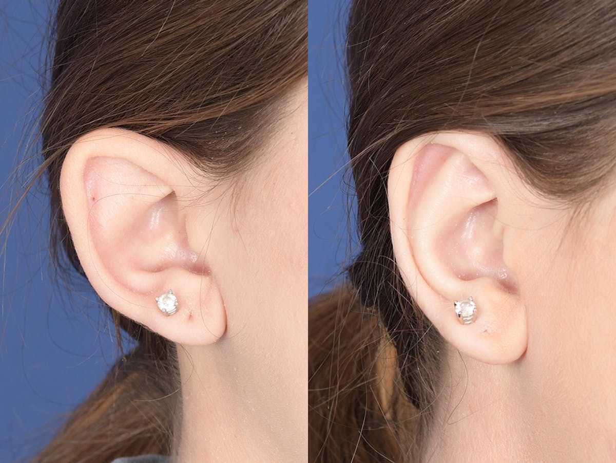 Otoplasty Before & After Gallery - Patient 253251 - Image 5
