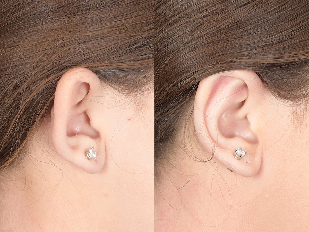 Otoplasty Before & After Gallery - Patient 253251 - Image 6
