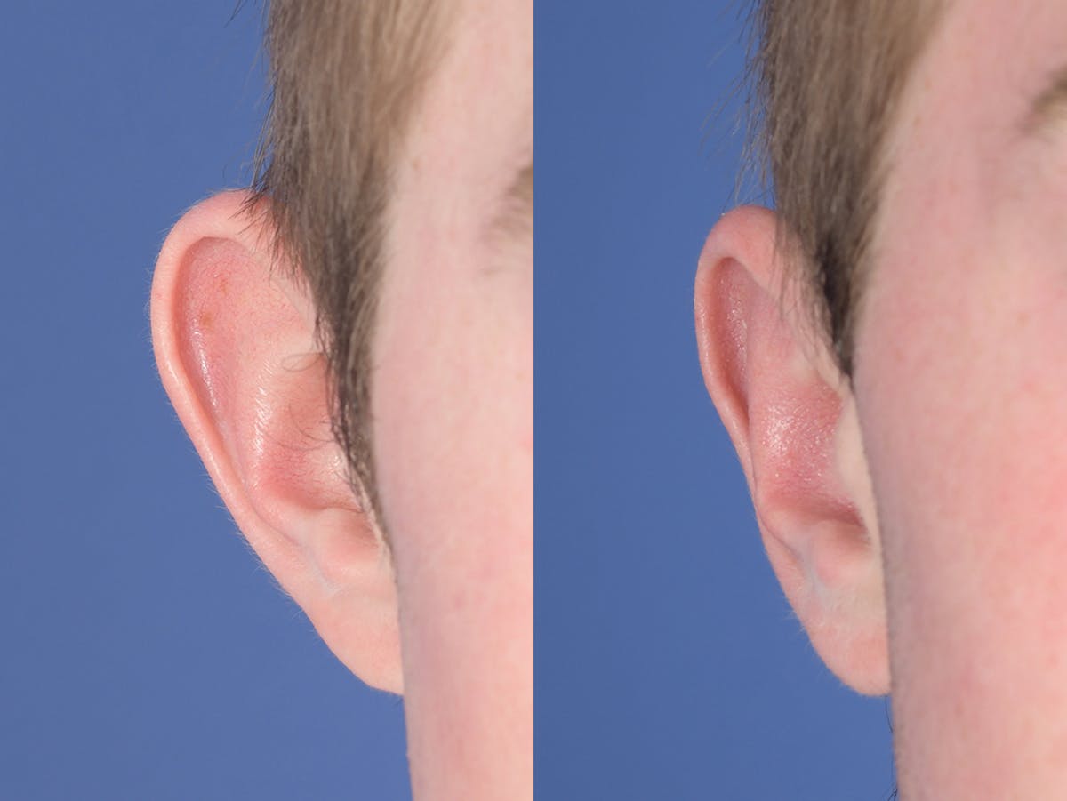 Otoplasty Before & After Gallery - Patient 373875 - Image 1