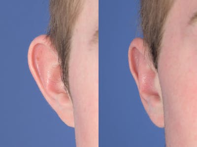 Otoplasty Before & After Gallery - Patient 373875 - Image 1