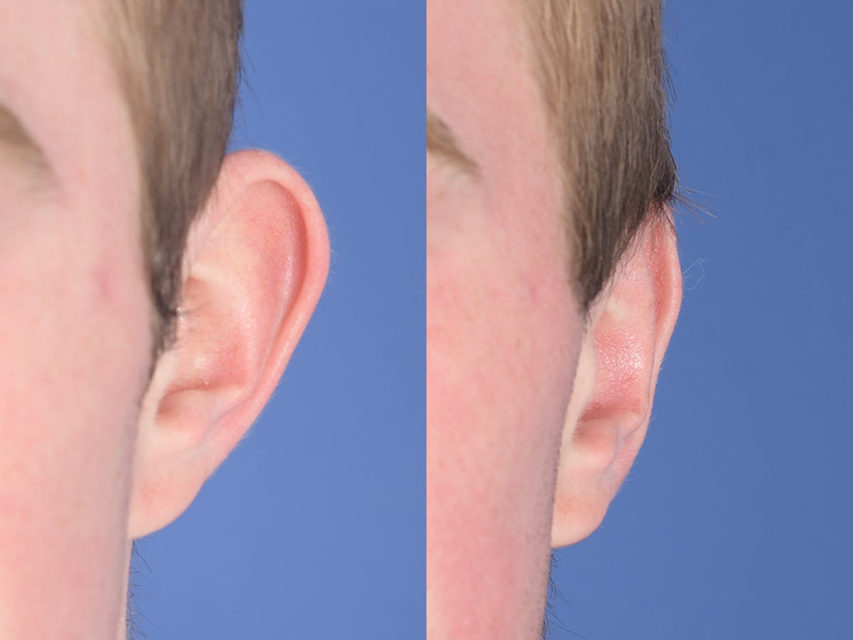 Otoplasty Before & After Gallery - Patient 373875 - Image 2