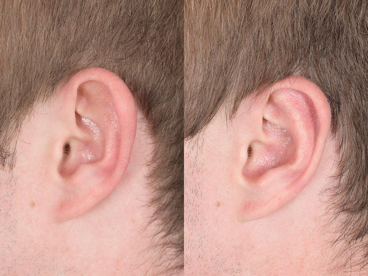 Otoplasty Before & After Gallery - Patient 373875 - Image 3