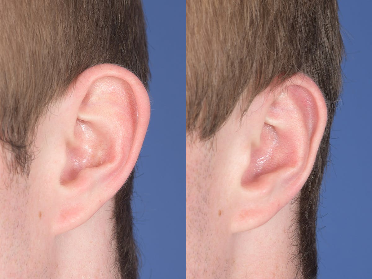 Otoplasty Before & After Gallery - Patient 373875 - Image 4