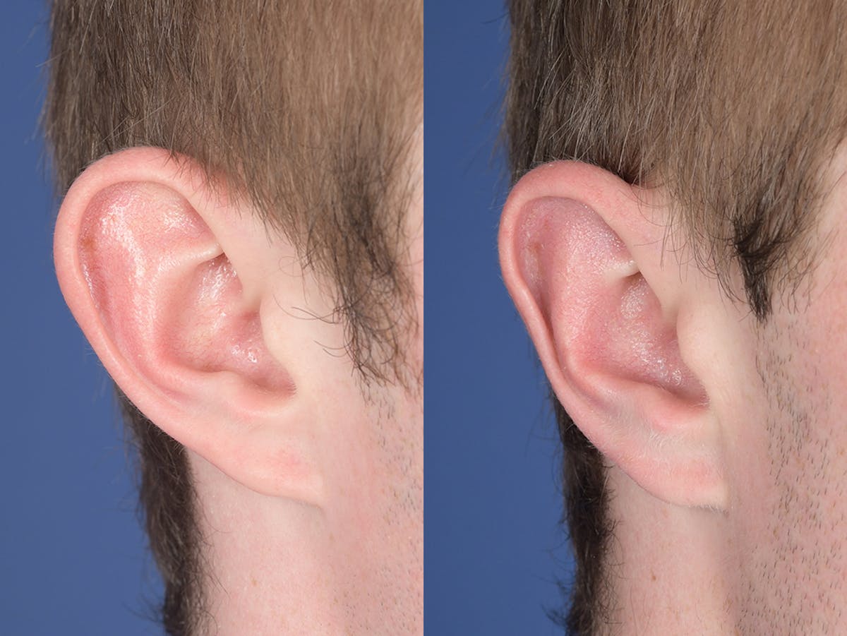 Otoplasty Before & After Gallery - Patient 373875 - Image 5