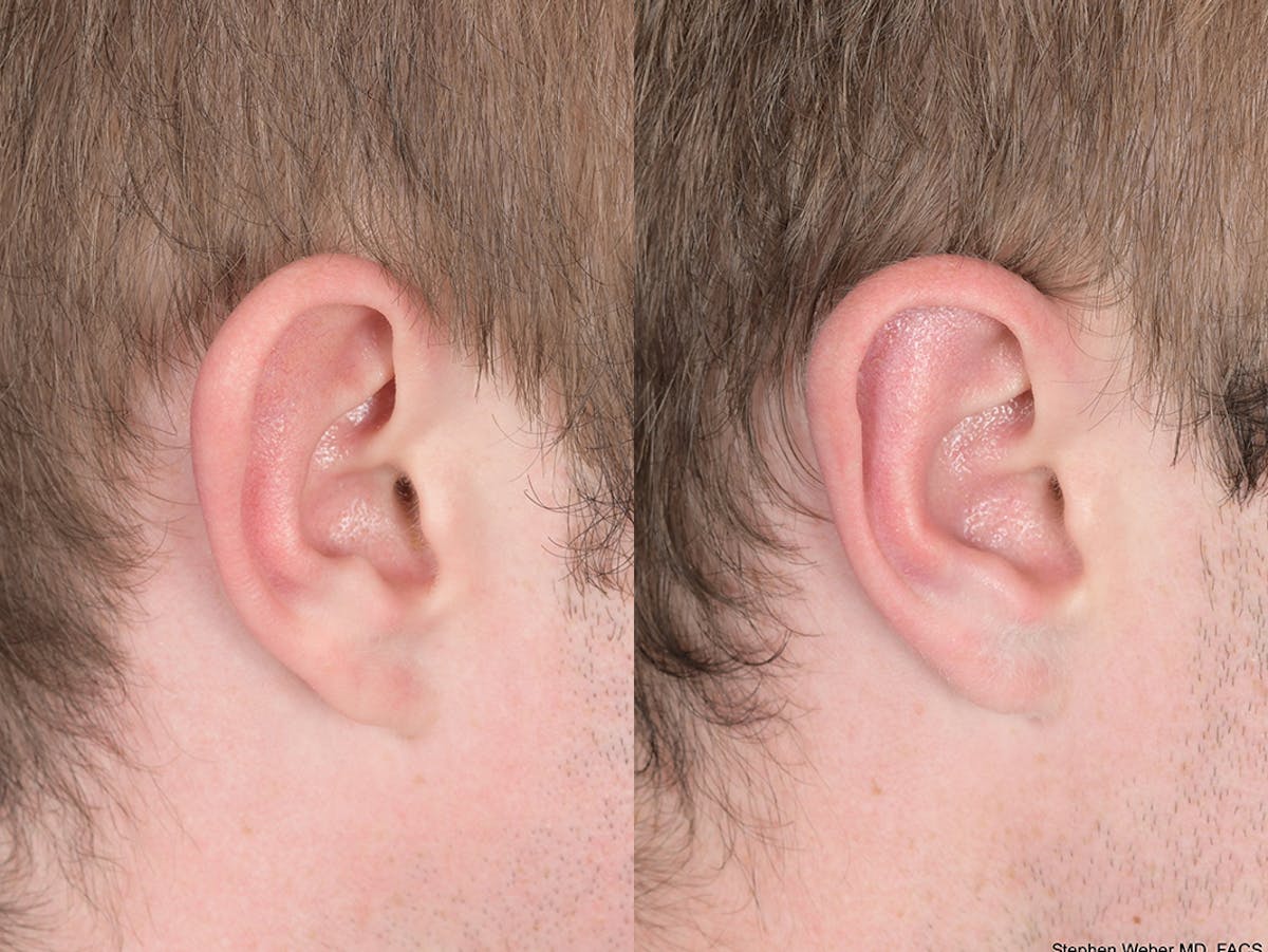 Otoplasty Before & After Gallery - Patient 373875 - Image 6