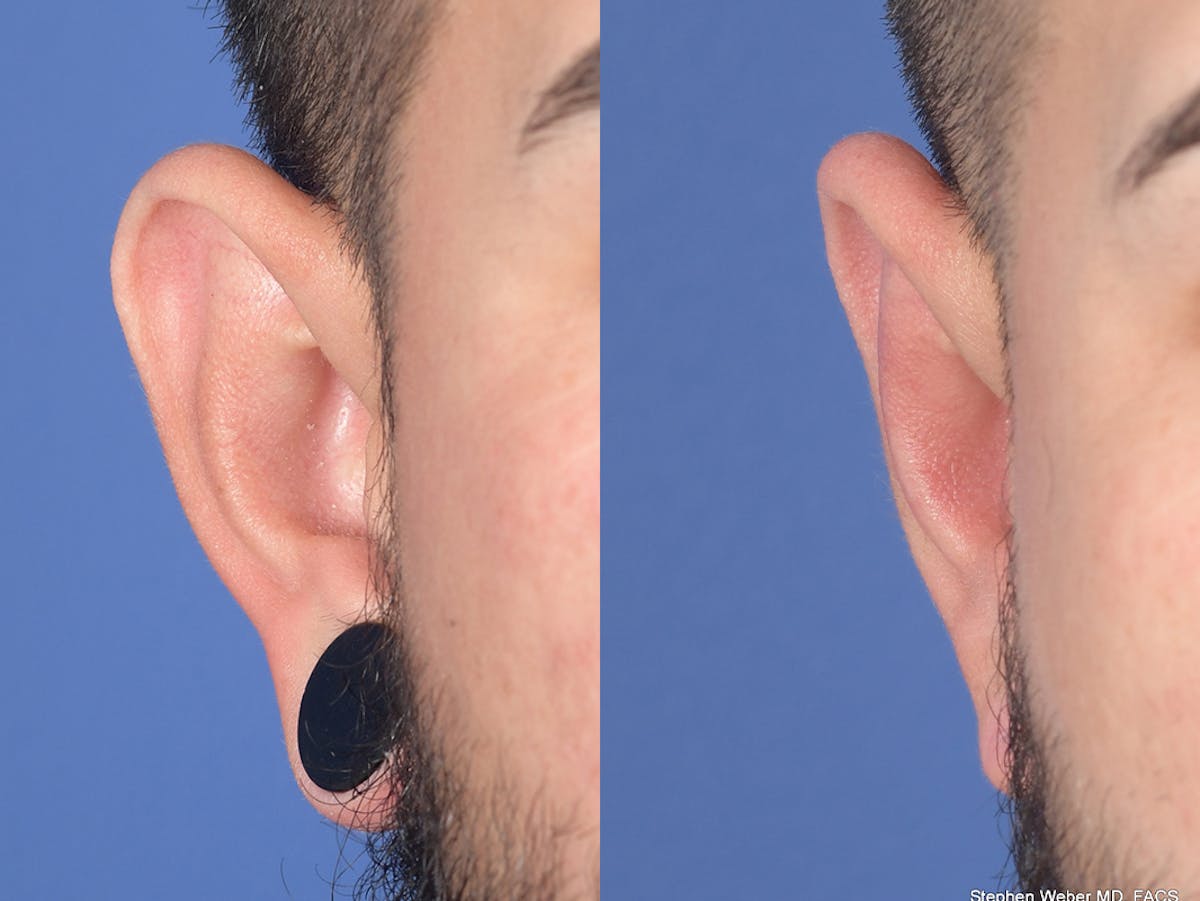 Otoplasty Before & After Gallery - Patient 400521 - Image 1