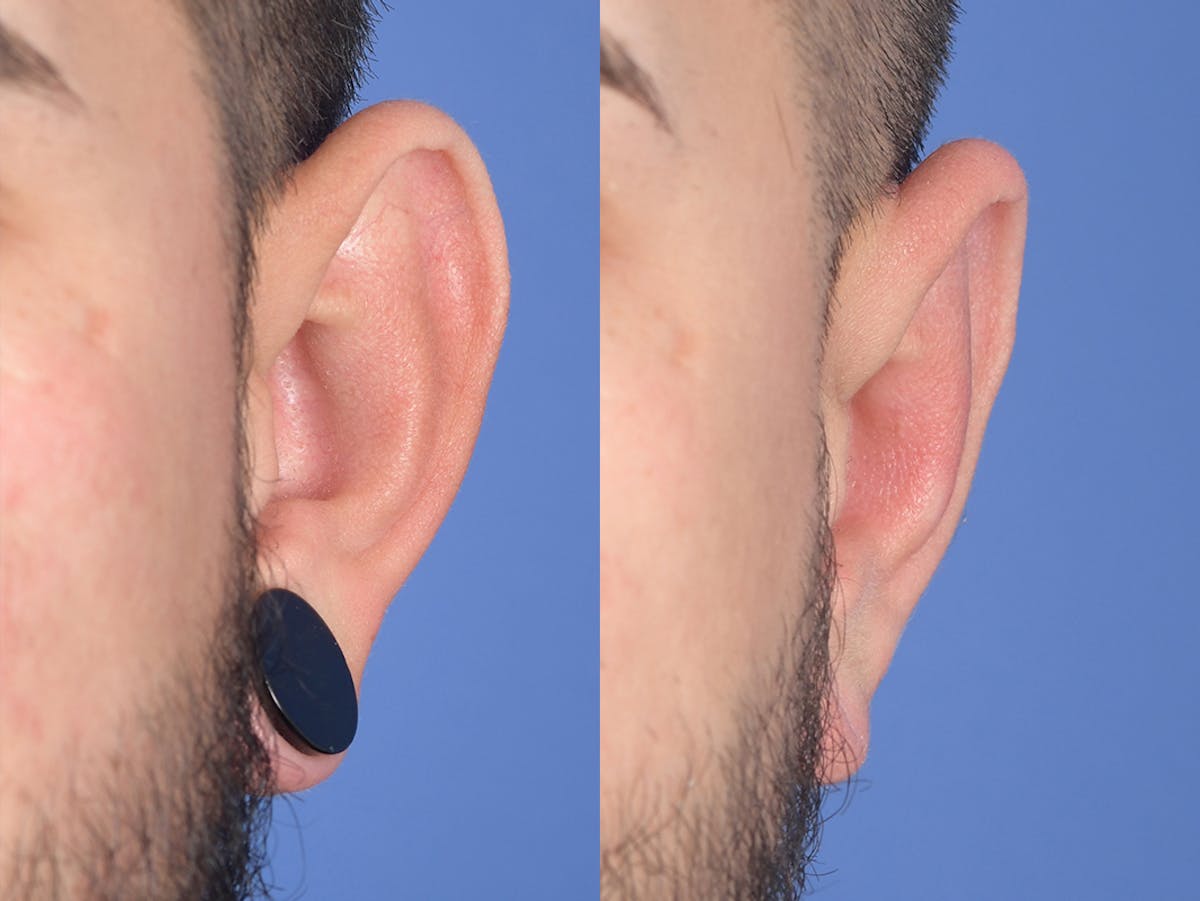 Otoplasty Before & After Gallery - Patient 400521 - Image 2