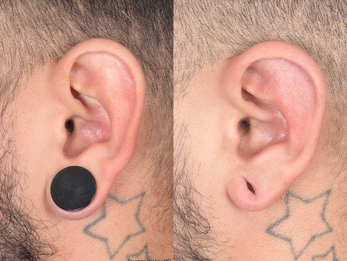 Otoplasty Before & After Gallery - Patient 400521 - Image 3