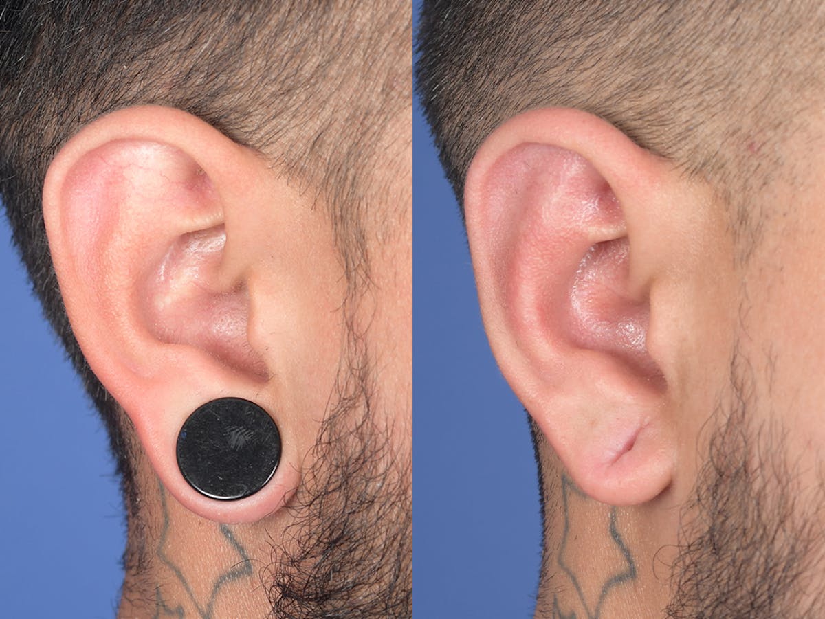 Otoplasty Before & After Gallery - Patient 400521 - Image 5