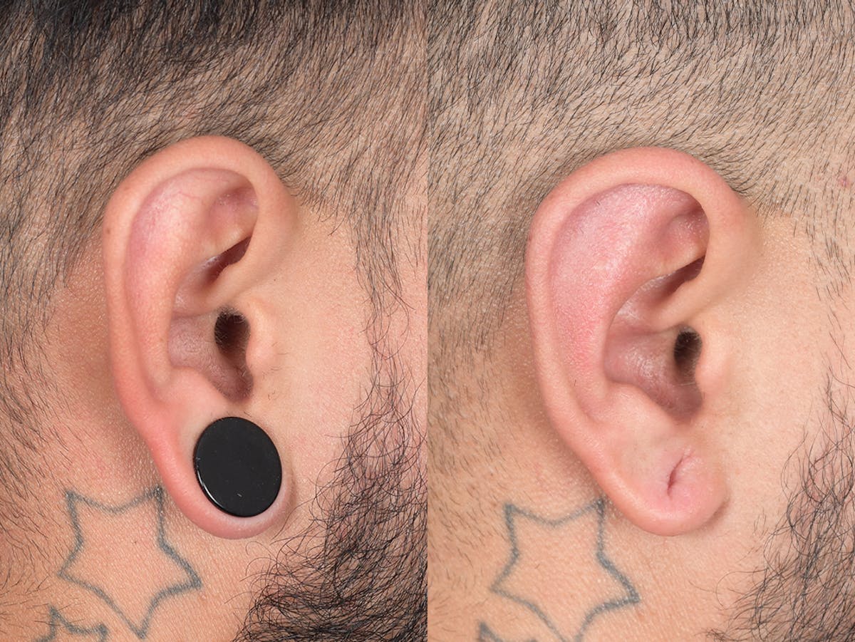 Otoplasty Before & After Gallery - Patient 400521 - Image 6