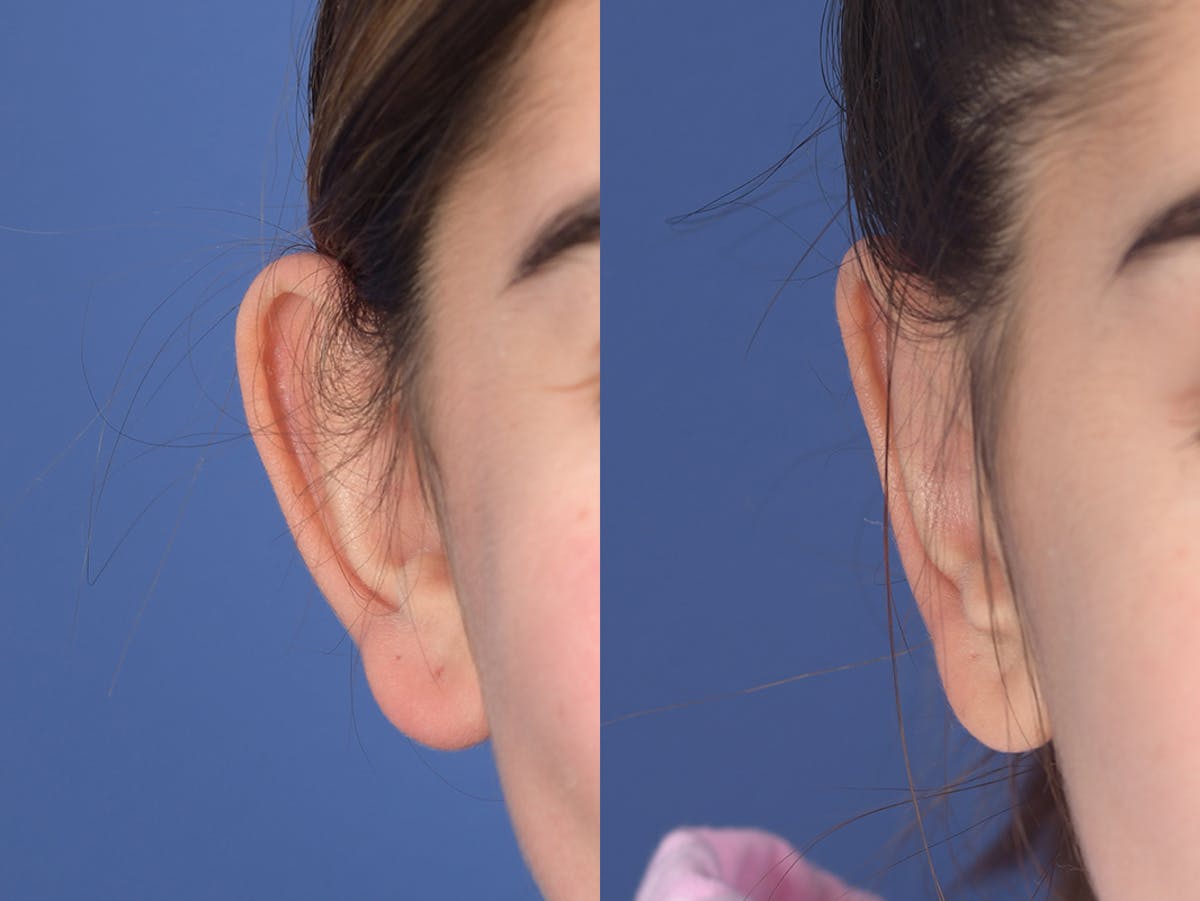 Otoplasty Before & After Gallery - Patient 784872 - Image 1