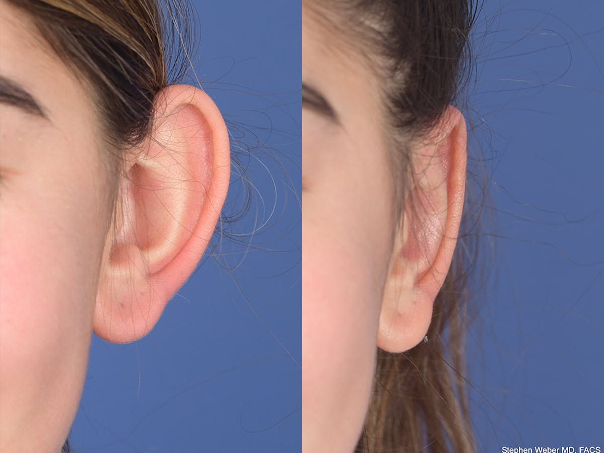 Otoplasty Before & After Gallery - Patient 784872 - Image 2