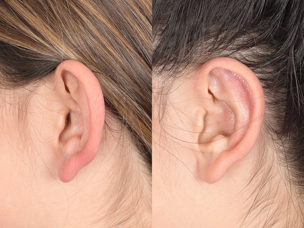 Otoplasty Before & After Gallery - Patient 784872 - Image 3
