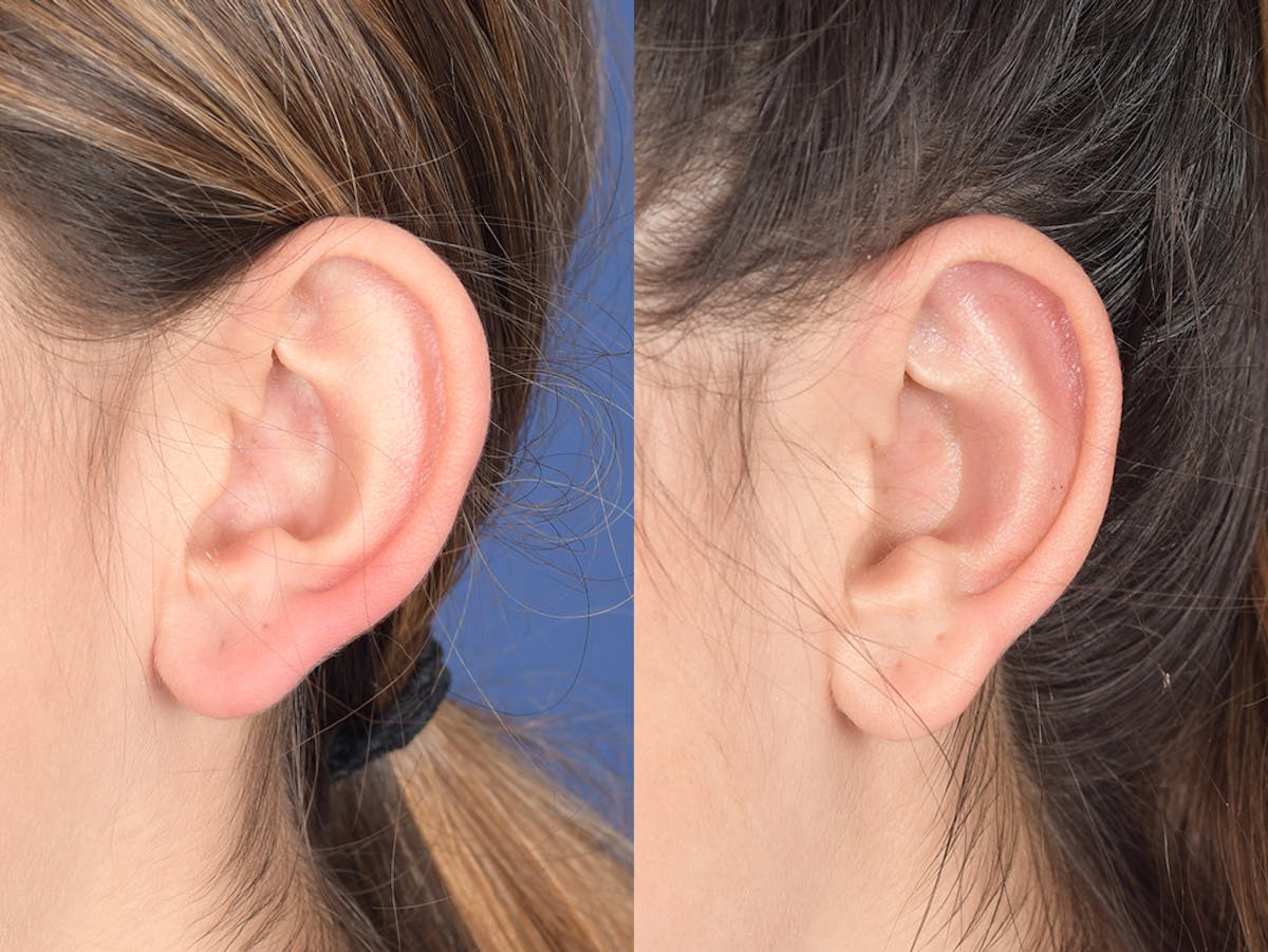 Otoplasty Before & After Gallery - Patient 784872 - Image 4