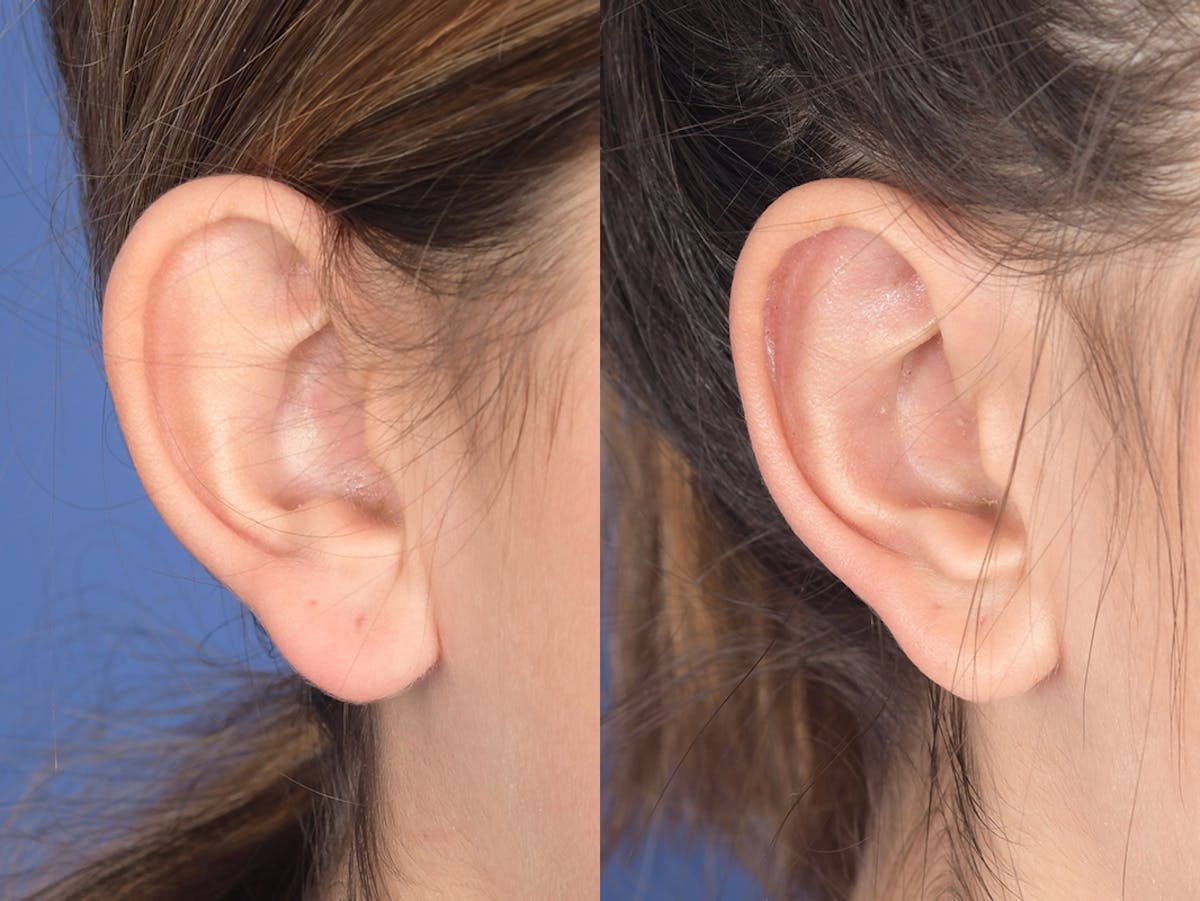 Otoplasty Before & After Gallery - Patient 784872 - Image 5