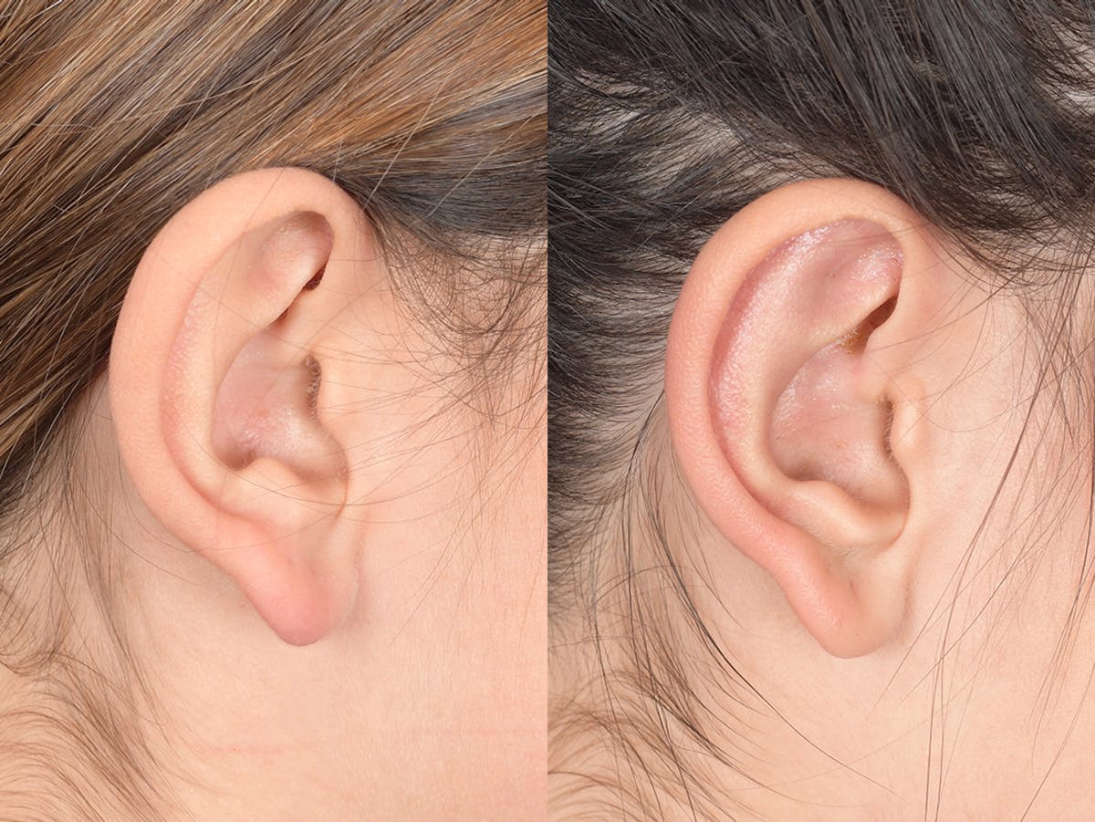 Otoplasty Before & After Gallery - Patient 784872 - Image 6