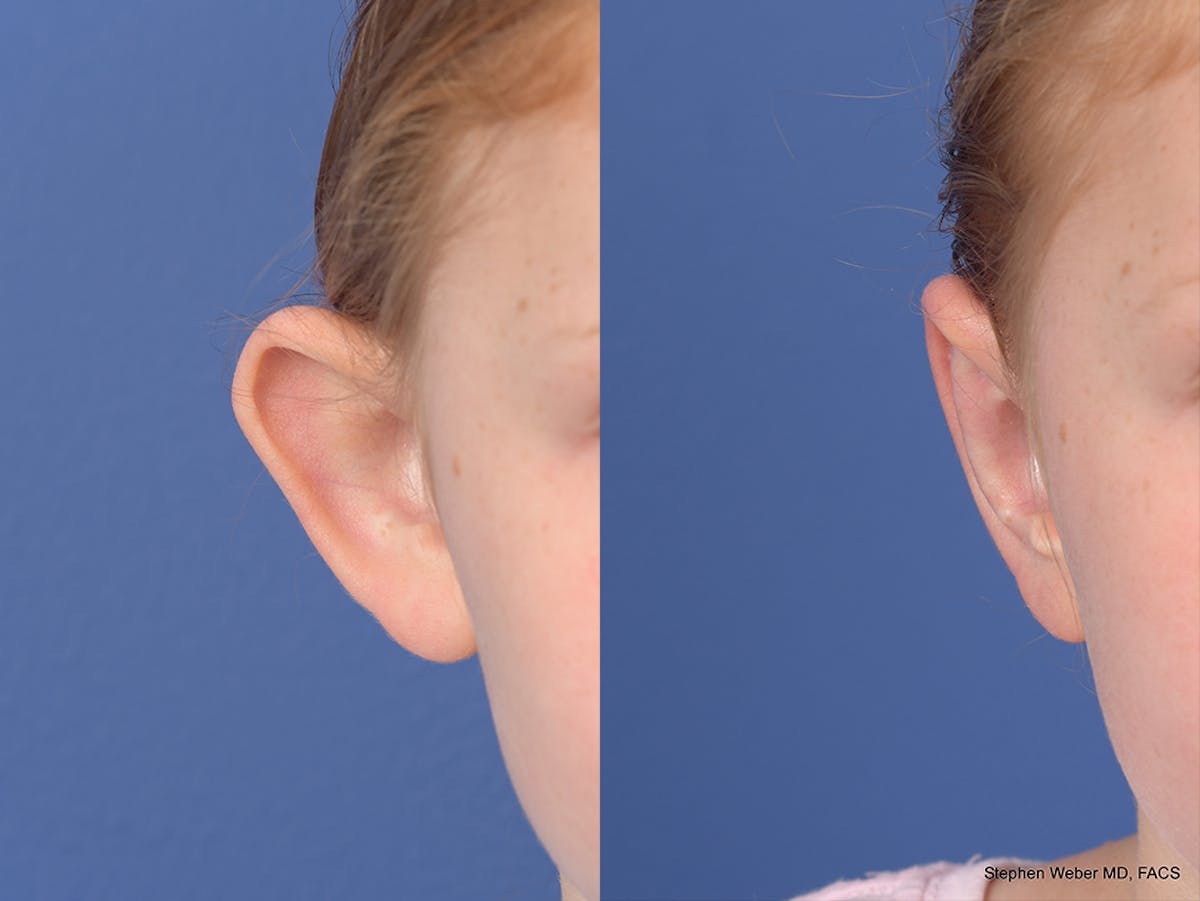 Otoplasty Before & After Gallery - Patient 376325 - Image 1