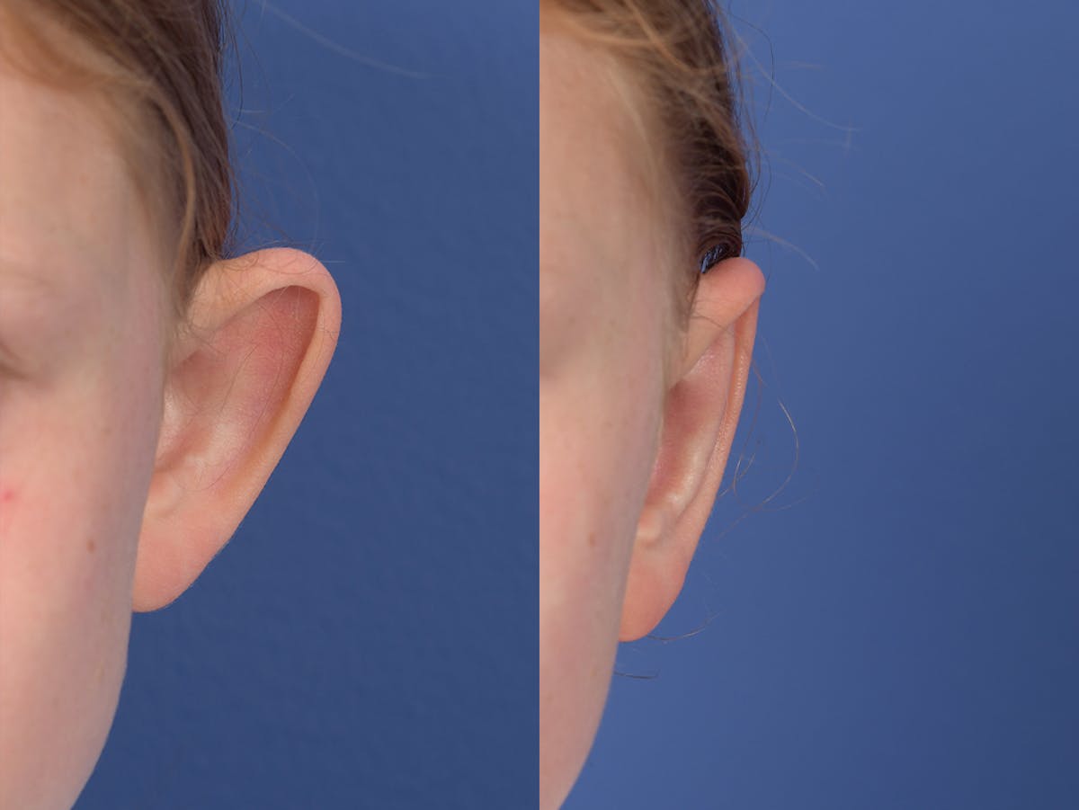 Otoplasty Before & After Gallery - Patient 376325 - Image 2