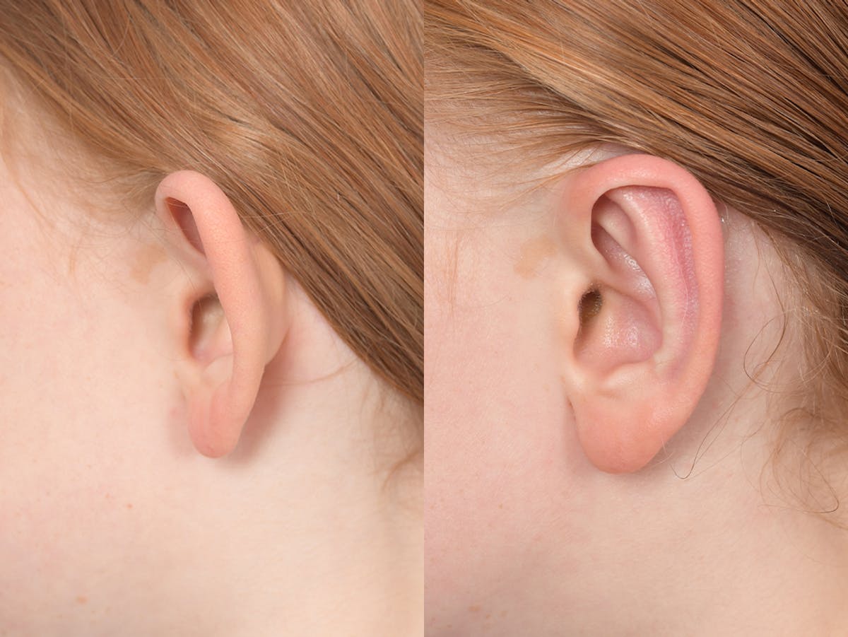 Otoplasty Before & After Gallery - Patient 376325 - Image 3