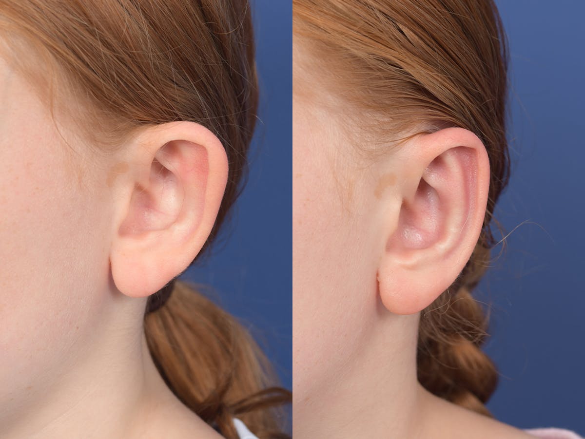 Otoplasty Before & After Gallery - Patient 376325 - Image 4