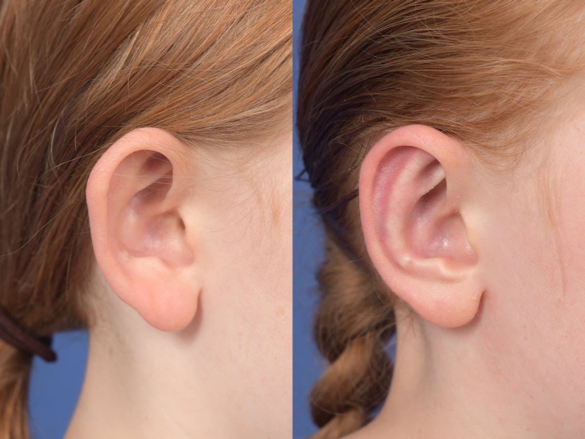 Otoplasty Before & After Gallery - Patient 376325 - Image 5