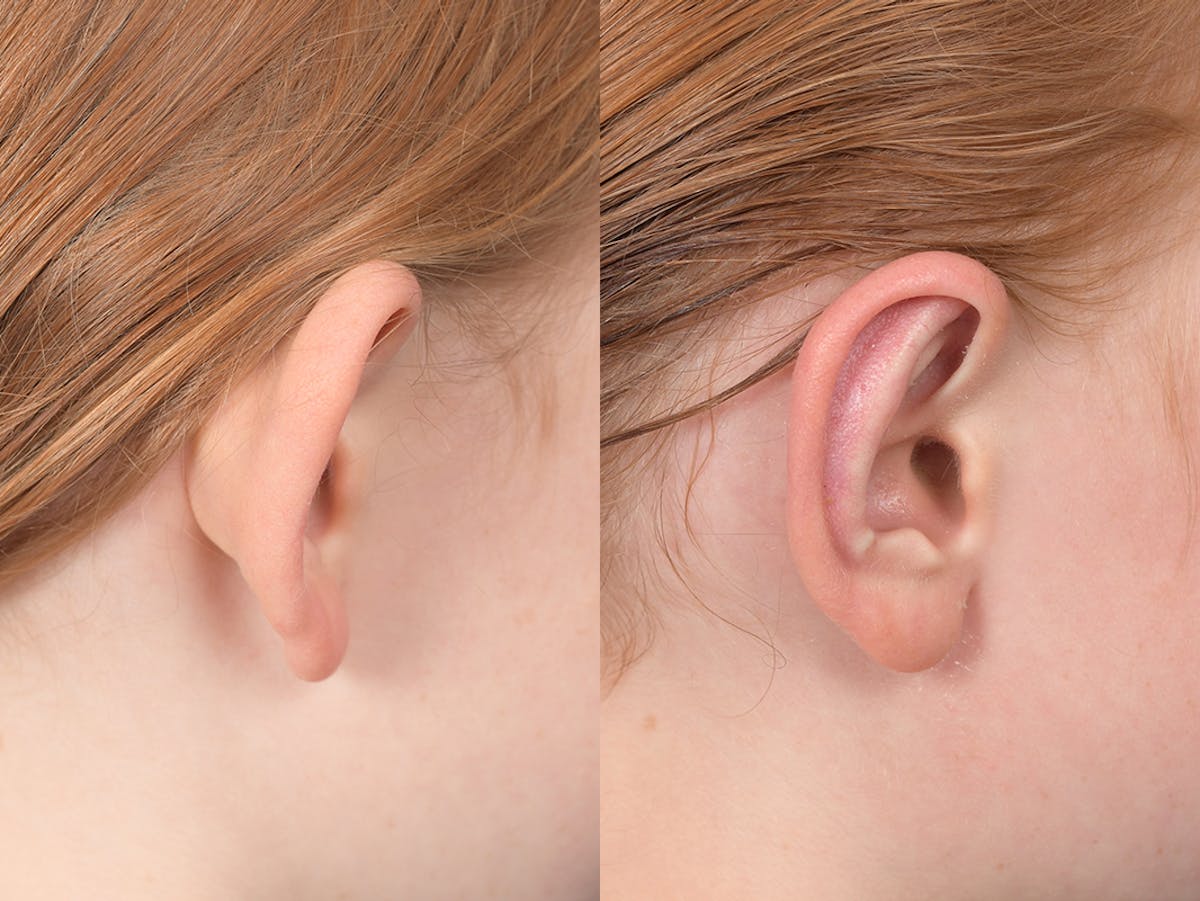 Otoplasty Before & After Gallery - Patient 376325 - Image 6