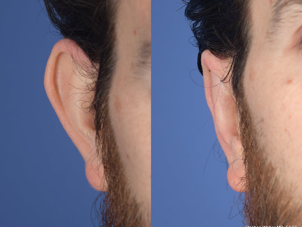 Otoplasty Before & After Gallery - Patient 406991 - Image 1