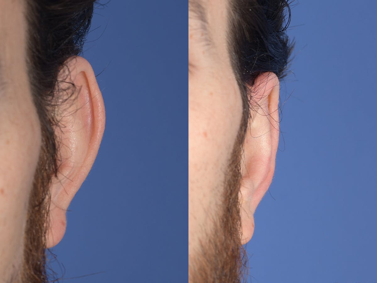 Otoplasty Before & After Gallery - Patient 406991 - Image 2