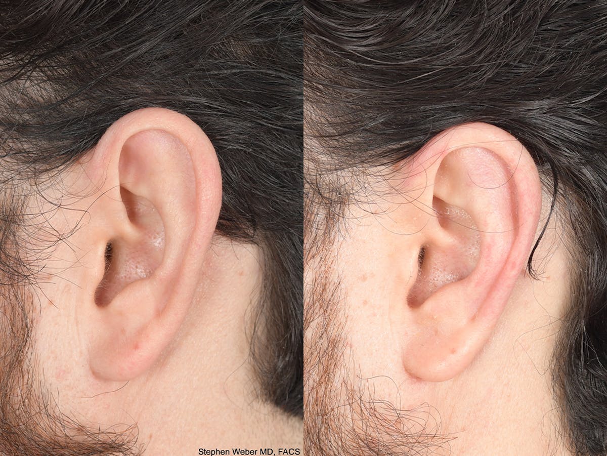 Otoplasty Before & After Gallery - Patient 406991 - Image 3