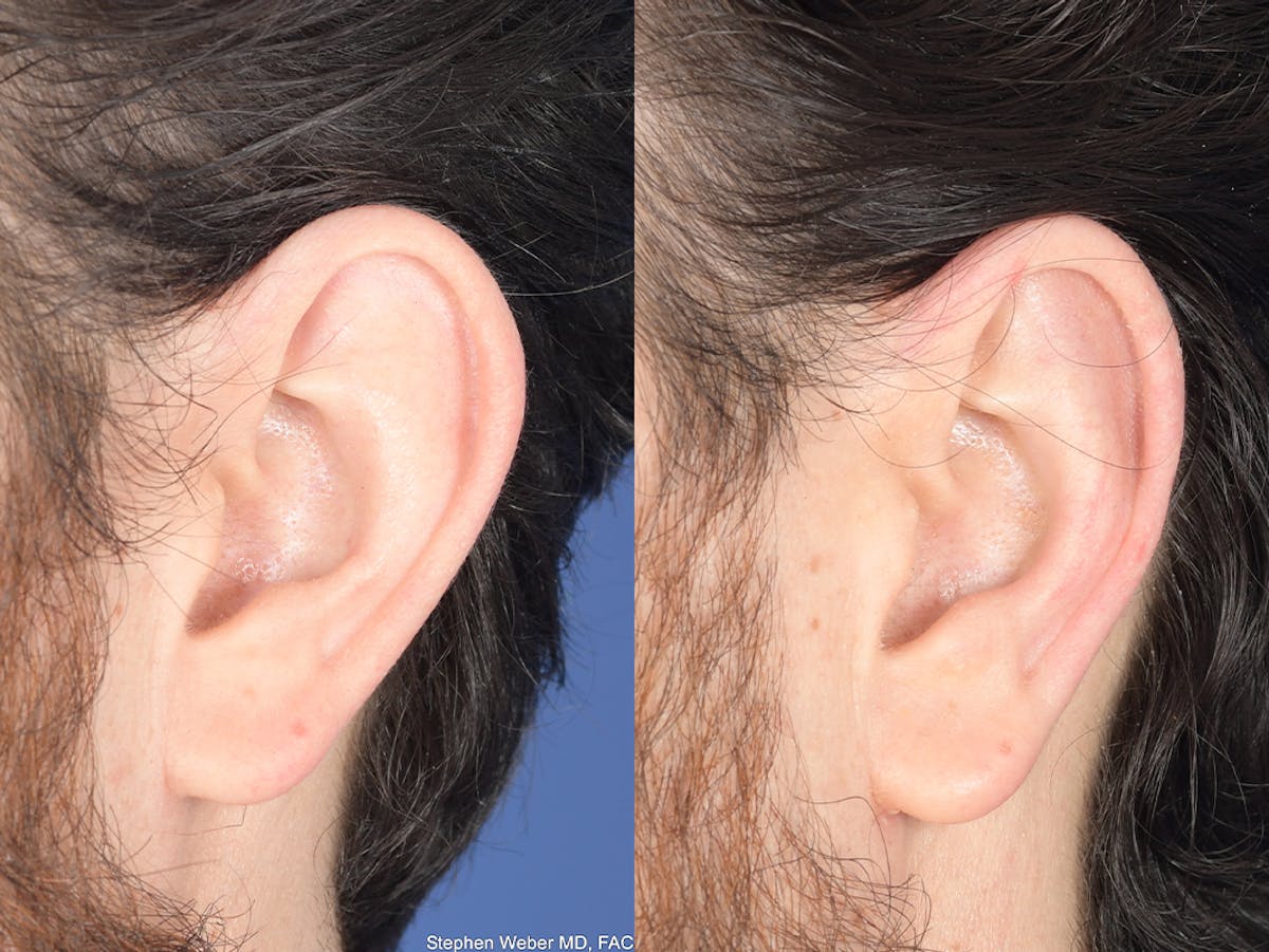 Otoplasty Before & After Gallery - Patient 406991 - Image 4