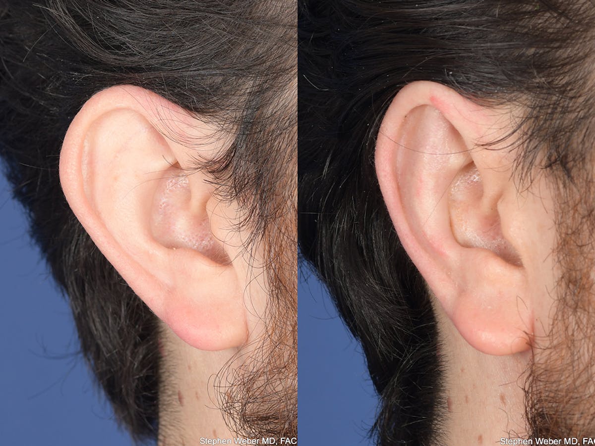 Otoplasty Before & After Gallery - Patient 406991 - Image 5
