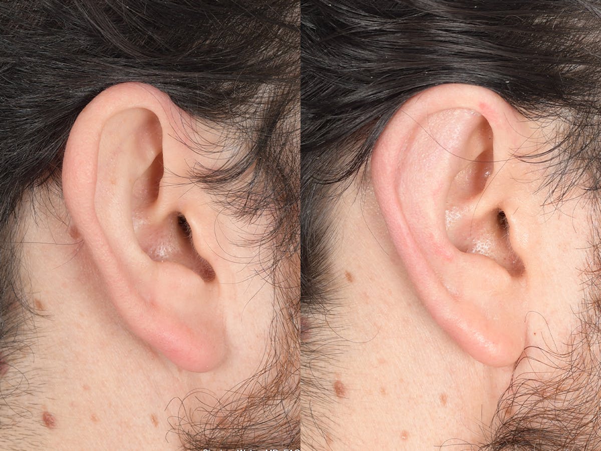 Otoplasty Before & After Gallery - Patient 406991 - Image 6