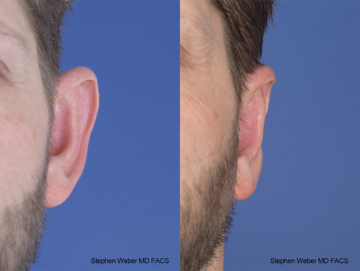 Otoplasty Before & After Gallery - Patient 369919 - Image 1