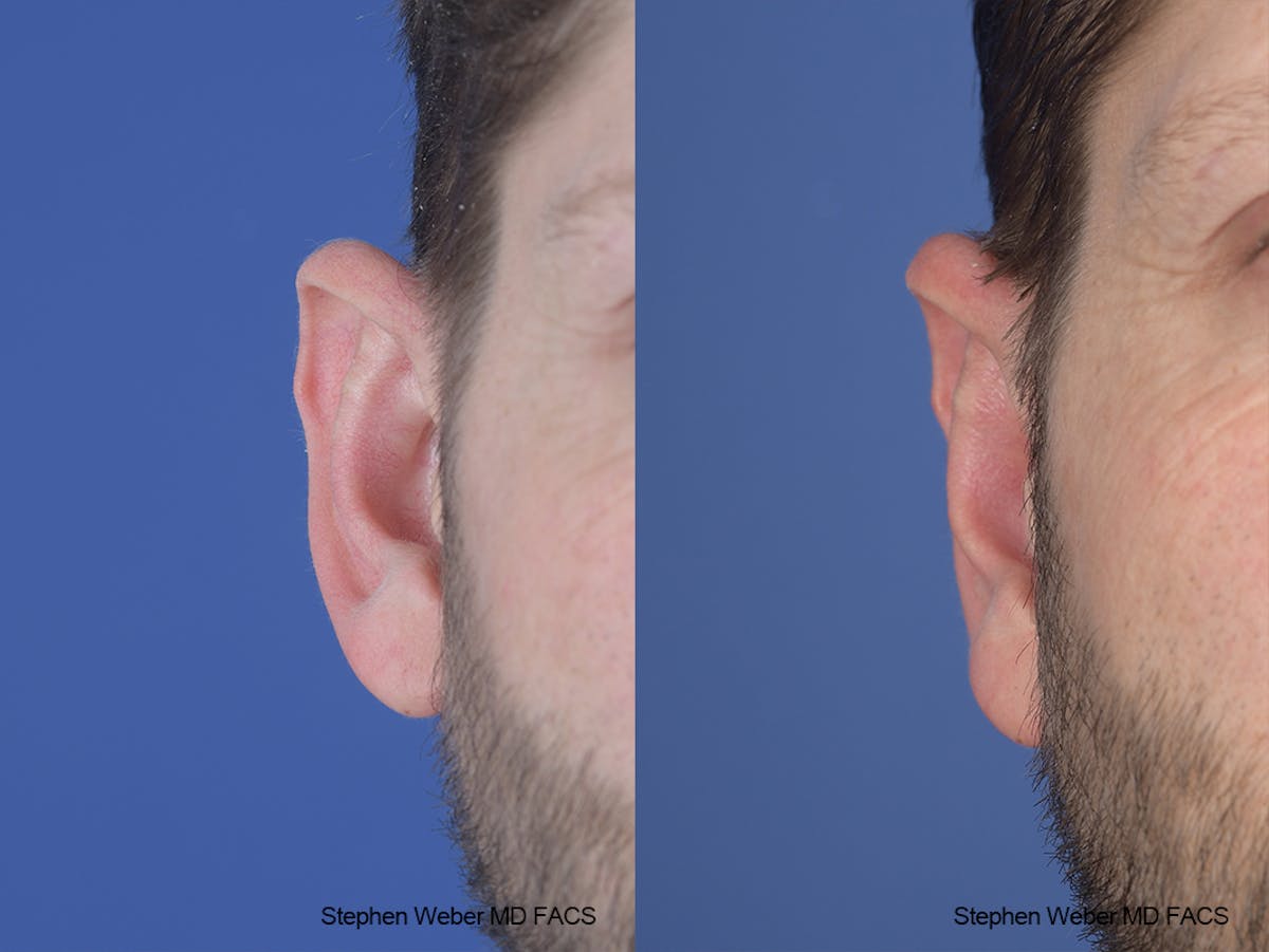 Otoplasty Before & After Gallery - Patient 369919 - Image 2