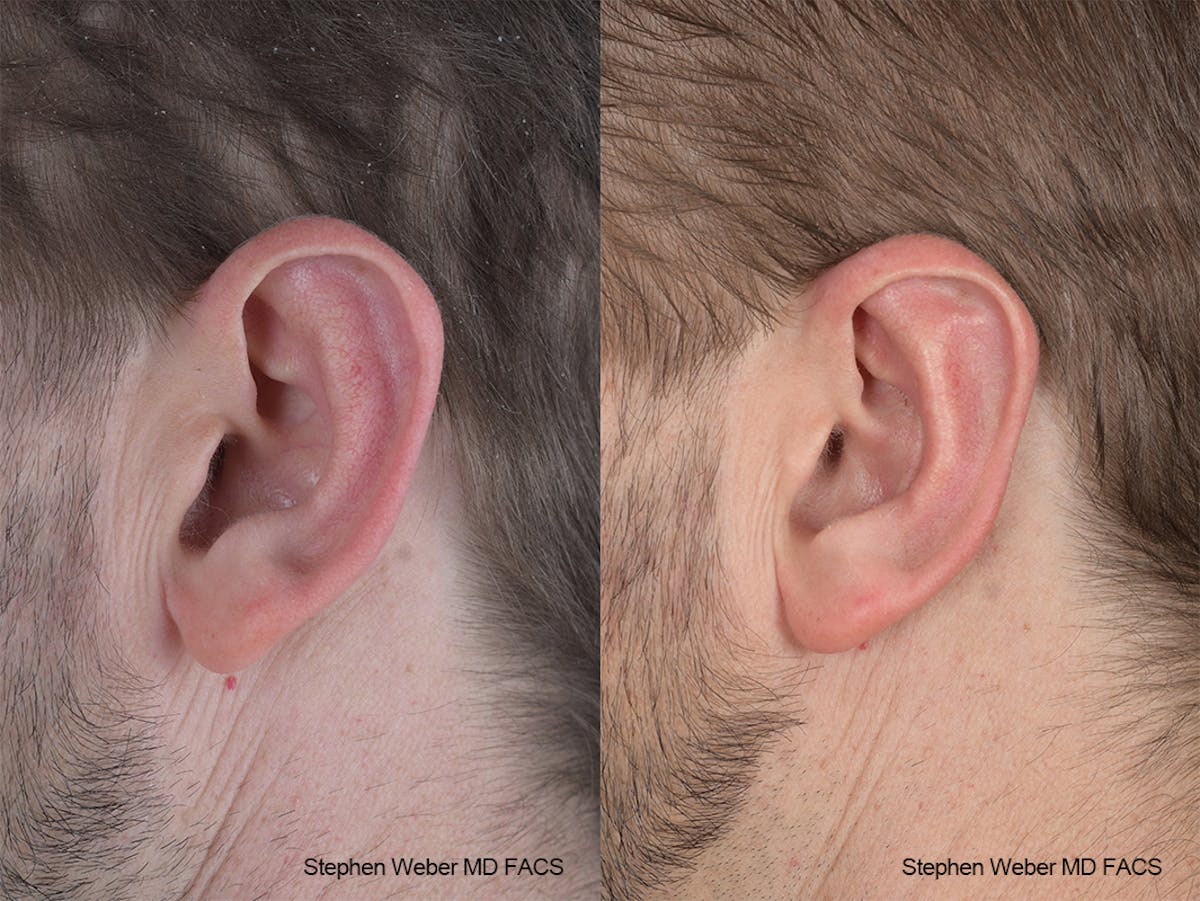 Otoplasty Before & After Gallery - Patient 369919 - Image 3