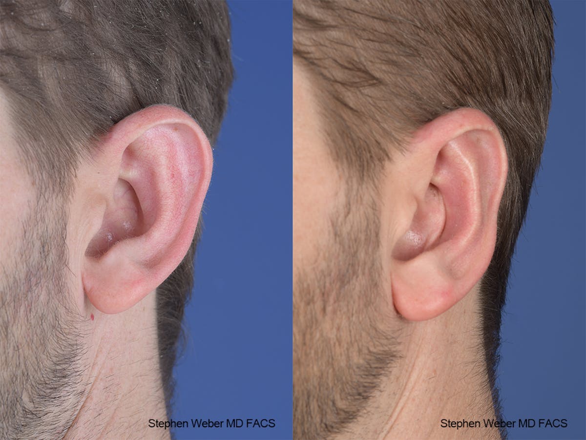 Otoplasty Before & After Gallery - Patient 369919 - Image 4