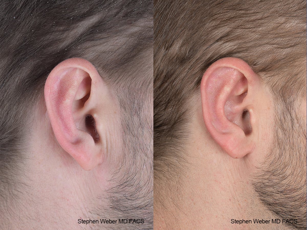 Otoplasty Before & After Gallery - Patient 369919 - Image 5