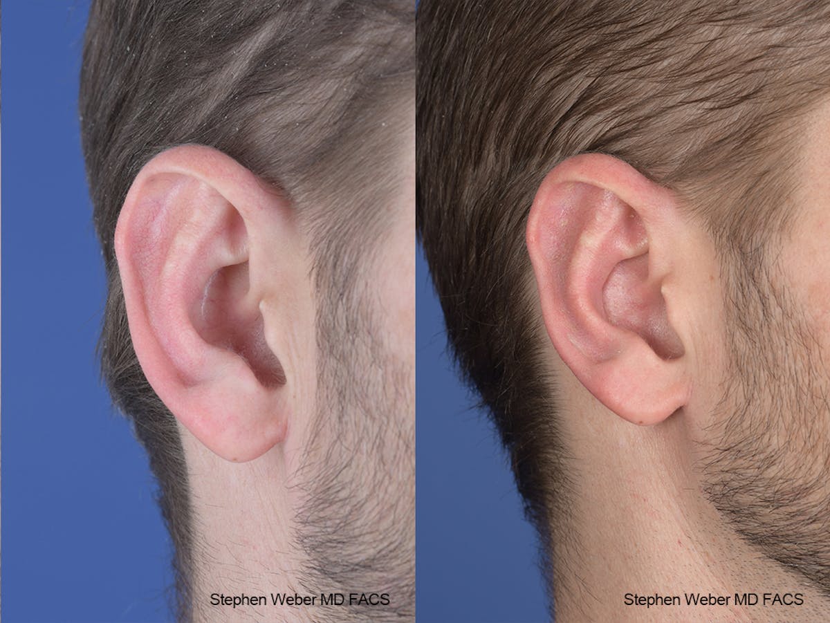 Otoplasty Before & After Gallery - Patient 369919 - Image 6