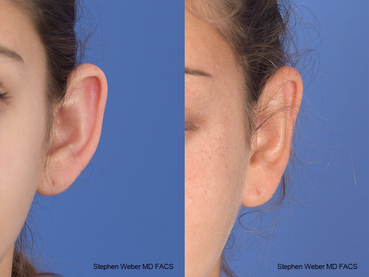 Otoplasty Before & After Gallery - Patient 240799 - Image 1