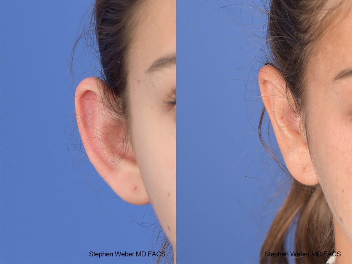 Otoplasty Before & After Gallery - Patient 240799 - Image 2