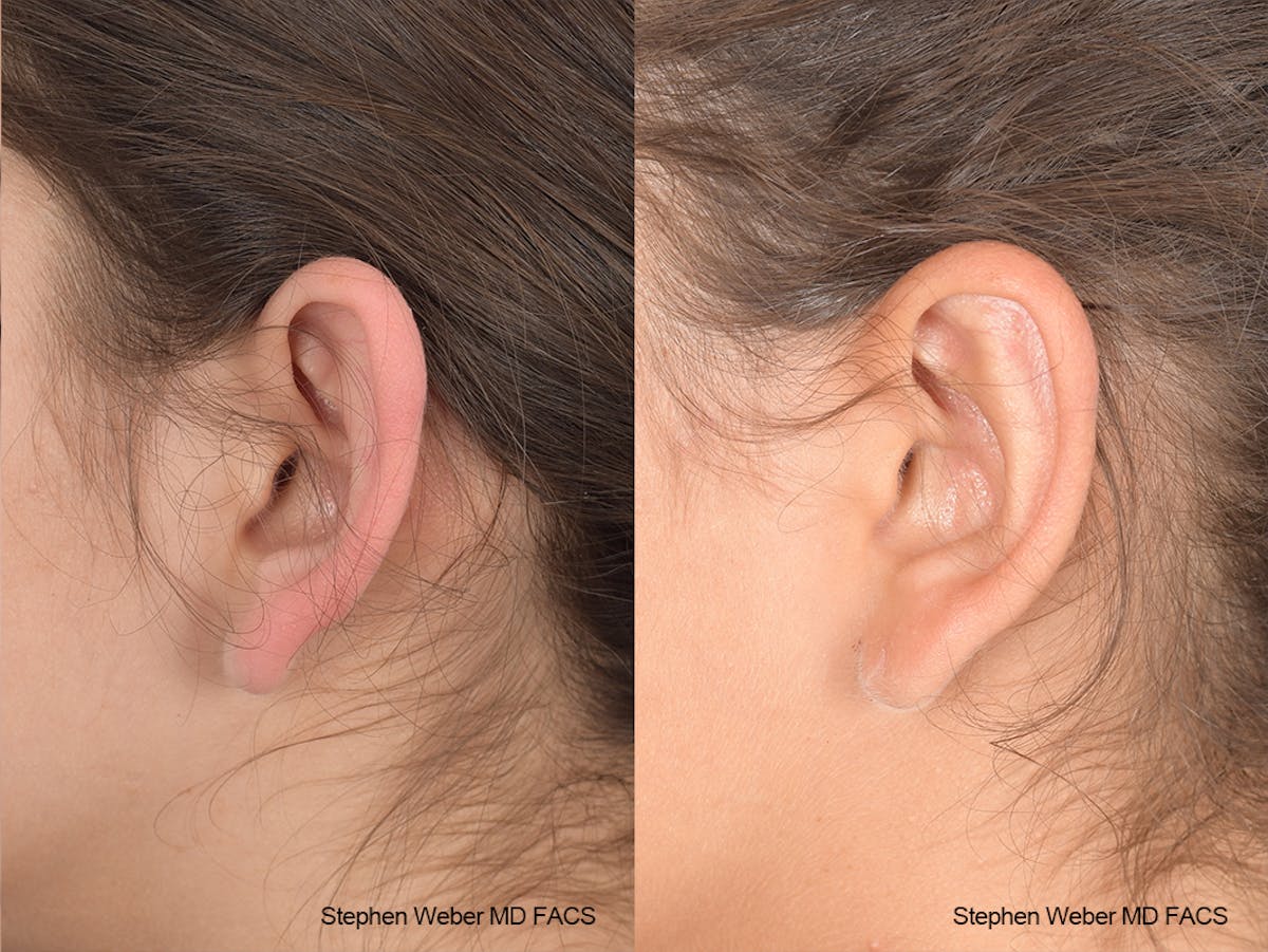 Otoplasty Before & After Gallery - Patient 240799 - Image 3