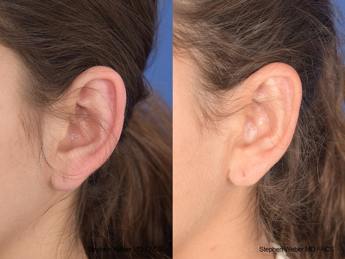 Otoplasty Before & After Gallery - Patient 240799 - Image 4