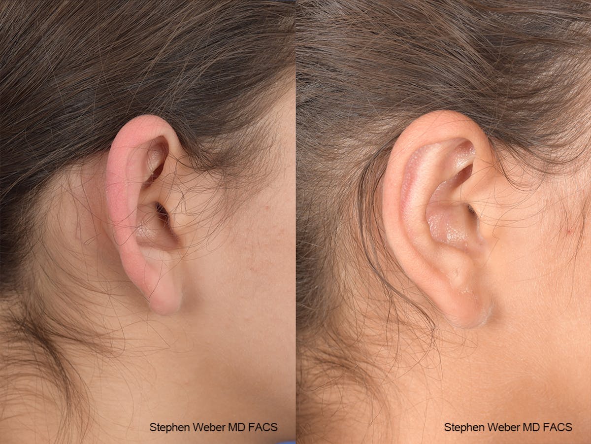 Otoplasty Before & After Gallery - Patient 240799 - Image 5