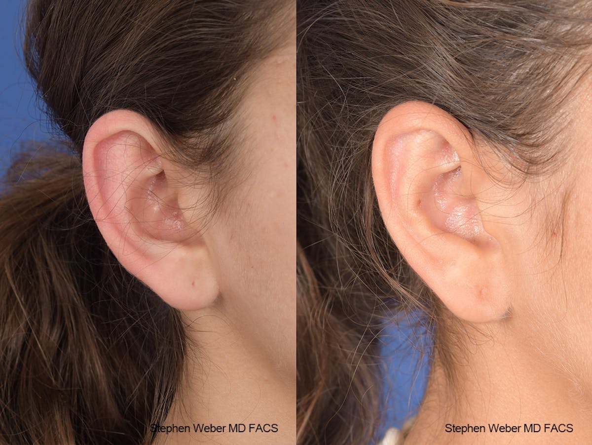 Otoplasty Before & After Gallery - Patient 240799 - Image 6